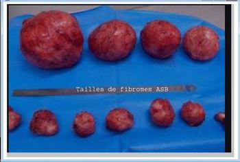 Fibromes Symptômes Traitements Naturels. Solution naturelle contre les Fibromes