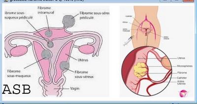 Gardnerella Vaginalis Traitements Naturels