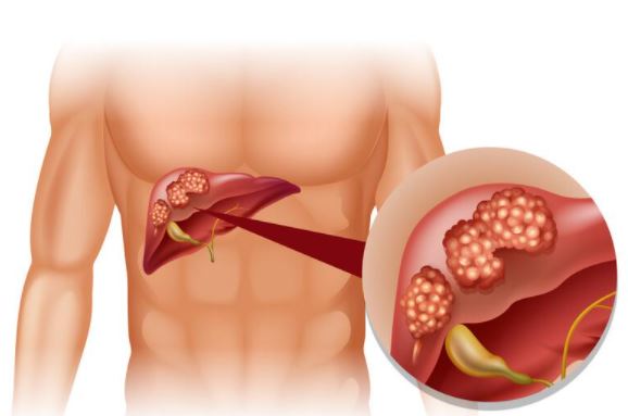 Cirrhose du Foie Causes Traitements Naturels
