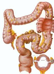 Diverticulose du Colon Traitements Naturels