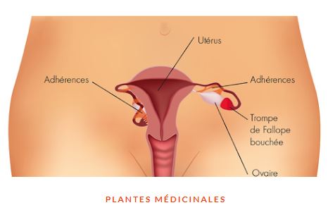 Cervicite Causes Symptômes Traitements Naturels