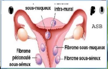 Mélanome Vulvaire Causes Traitements Naturels