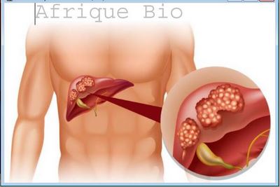 Pneumonie Causes Traitement Naturel