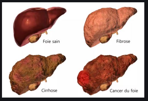 Métastase Causes Symptômes Traitements