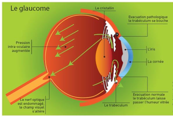 Daltonisme causes conséquences Traitements