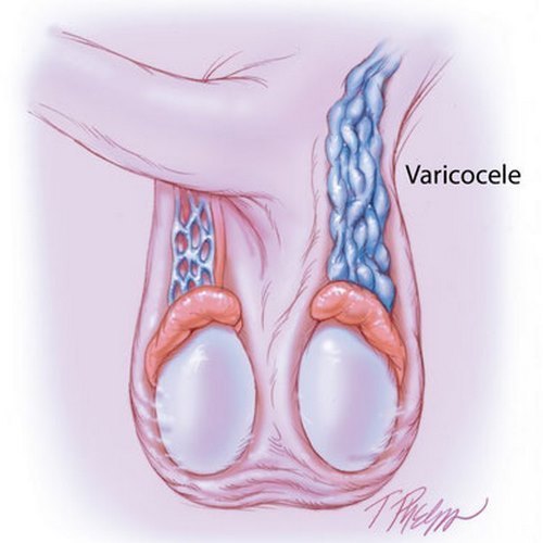 Guérir de la Varicocèle Naturellement sans Opération Chirurgicale
