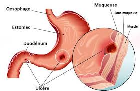 Mucoviscidose Causes Traitement Naturel