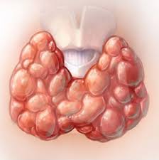 Goitre et hyperthyroïdie Traitement Naturel