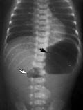 Occlusion Intestinale Traitement Naturel. Solution Naturelle Occlusion Intestinale