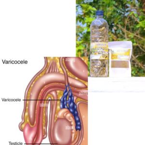 Meilleure Tisane pour Vaincre Naturellement la Varicocèle sans chirurgie