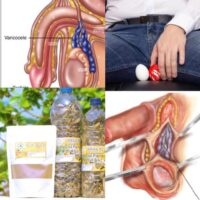 Tisane pour Vaincre Naturellement la Varicocèle