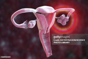 Ovaires polykystiques, Remède Naturel Kystes ovariens