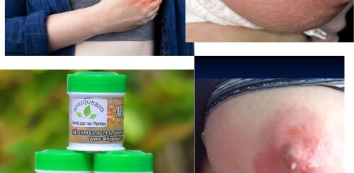 Mastite Causes Traitement Naturel