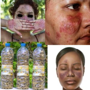 Remède pour Soigner La lupus