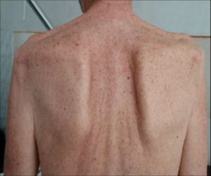 Dystrophie Musculaire Traitement Naturel