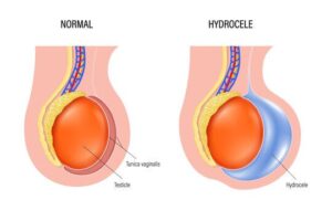 Hydrocèle Vaginale Traitement Naturel