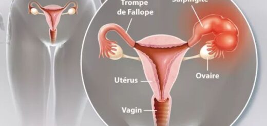 Comment Guérir la Salpingite