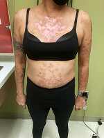 Lupus Prévention et Thérapie Naturelle