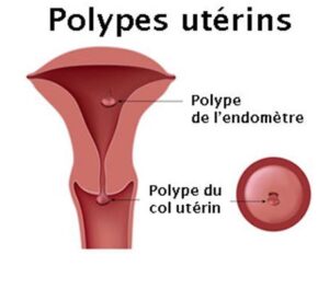 Tisane pour Guérir des Polypes Utérins