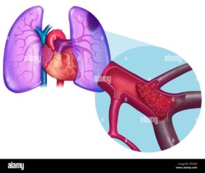 Embolie Pulmonaire Traitement Naturel