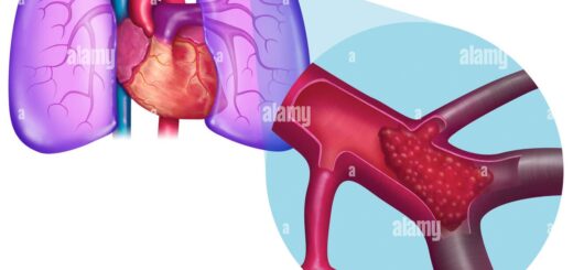 Embolie Pulmonaire Traitement Naturel