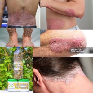 Remède pour Guérir le Psoriasis