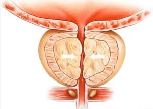 Remède Naturel Contre le Cancer de la Prostate