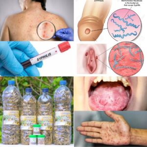 Remède pour Guérir du Syphilis Naturellement