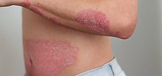 Psoriasis Causes Symptômes Solution Naturelle contre le Psoriasis