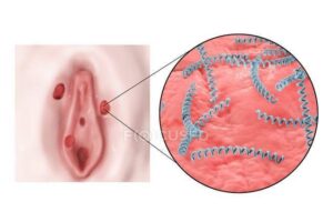 Remède pour Guérir du Syphilis Naturellement