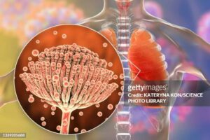 Traitement Naturel de l'Aspergillose. Comment soigner une aspergillose naturellement. Voici un bon Traitement Naturel qui guérit l'aspergillose de façon naturelle avec les plantes antibiotiques. Comment Soigner une Aspergillose de façon naturelle découvrez ici notre super remèdeCliquez ici pour avoir le meilleur remède pour soigner l'Aspergillose Aspergillose Pulmonaire : Traitement Naturel de l'Aspergillose Recherches associées : Aspergillose Pulmonaire Remède Naturel Aspergillose pulmonaire traitement naturel, aspergillose pulmonaire remède naturel, Aspergillose broncho pulmonaire allergique solution naturelle, Diagnostic et traitement de l'aspergillose, Aspergillose bronchopulmonaire allergique remède naturel Aspergillose Remède Naturel Aspergillose, Aspergillose pulmonaire nécrosante chronique solution naturelle, Aspergillose - Symptômes, Diagnostic, Traitement, Risques, l'infection du champignon Aspergillus traitement naturel, Comment guérir de l'aspergillose naturellement, Quel est l'agent causal de l'aspergillose pulmonaire, Comment soigner une infection fongique naturellement, Comment faire disparaître des champignon naturellement L’aspergillose, qu'est-ce que c'est ? L'aspergillose est une infection fongique causée par le champignon Aspergillus. Ce champignon est présent dans l'environnement et se retrouve souvent dans le sol, les débris végétaux en décomposition, et même dans l'air intérieur et extérieur. Dans la plupart des cas, l'aspergillose ne provoque pas de maladie chez les personnes en bonne santé, car leur système immunitaire est capable de contrôler la croissance du champignon. Cependant, chez les personnes dont le système immunitaire est affaibli, comme celles qui ont des troubles pulmonaires sous-jacents ou un système immunitaire compromis, l'aspergillose peut causer des infections graves. Nous joindre ici pour en savoir plus Les différentes types d'aspergilloses : Traitement Naturel de l'Aspergillose 1°Aspergillose broncho-pulmonaire allergique (ABPA) : Il s'agit d'une réaction allergique à la présence d'Aspergillus dans les poumons. Les symptômes comprennent une toux persistante, des difficultés respiratoires, des sifflements et parfois de la fièvre. 2°Aspergillose pulmonaire invasive (API) : C'est une infection grave dans laquelle le champignon envahit les tissus pulmonaires. Les symptômes peuvent inclure une toux sévère, une fièvre persistante, des douleurs thoraciques et une difficulté respiratoire. En savoir plus 3°Aspergillose sinusienne : Cette forme d'aspergillose affecte les sinus et peut provoquer des symptômes tels que des douleurs faciales, une congestion nasale, des saignements de nez et des maux de tête. 4°Aspergillose cutanée : Elle se manifeste par des lésions cutanées et des ulcères sur la peau qui peuvent être sensibles et douloureux. 5°Aspergillose systémique : C'est une forme grave d'aspergillose qui affecte généralement les personnes ayant un système immunitaire affaibli. Elle peut se propager à d'autres organes du corps et provoquer des symptômes généralisés. Cliquez ici pour avoir le meilleur remède pour soigner l'Aspergillose Les Causes de l’aspergillose : Traitement Naturel de l'Aspergillose L'aspergillose est principalement causée par l'inhalation de spores du champignon Aspergillus. Ces spores sont présentes dans l'environnement, en particulier dans le sol, les débris végétaux en décomposition, le compost, les grains, et même dans l'air intérieur et extérieur. Les spores d'Aspergillus sont très répandues et peuvent être inhalées quotidiennement sans provoquer de maladie chez la plupart des personnes en bonne santé, car leur système immunitaire est capable de contrôler la croissance du champignon. Cependant, chez certaines personnes, l'inhalation de spores d'Aspergillus peut entraîner des infections fongiques, en particulier chez celles dont le système immunitaire est affaibli ou qui ont des troubles pulmonaires sous-jacents. Les facteurs de risque qui peuvent augmenter la susceptibilité à l'aspergillose comprennent : Nous joindre ici pour en savoir plus Immunodéficience : Les personnes dont le système immunitaire est affaibli en raison de maladies telles que le VIH/SIDA, le cancer, le diabète, la leucémie, la greffe d'organe ou de moelle osseuse, ou qui prennent des médicaments immunosuppresseurs, sont plus susceptibles de développer une aspergillose. Maladies pulmonaires sous-jacentes : Les personnes atteintes de maladies pulmonaires chroniques telles que la bronchopneumopathie chronique obstructive (BPCO), la fibrose kystique, l'emphysème, l'asthme sévère ou la tuberculose sont plus susceptibles de développer une aspergillose pulmonaire. Discutez ici avec un Spécialiste Autres Causes de l'aspergillose : Traitement Naturel de l'Aspergillose Traumatisme thoracique : Les blessures thoraciques ou les interventions chirurgicales dans la région thoracique peuvent augmenter le risque d'aspergillose pulmonaire invasive. Consommation de corticostéroïdes : Les personnes qui prennent des corticostéroïdes à long terme pour traiter des maladies telles que l'asthme, la polyarthrite rhumatoïde ou la maladie de Crohn peuvent avoir un risque accru d'aspergillose. Exposition professionnelle : Certains travailleurs, tels que les agriculteurs, les travailleurs de la construction, les jardiniers et les travailleurs du secteur du bois, peuvent être exposés à des concentrations élevées de spores d'Aspergillus sur leur lieu de travail, ce qui peut augmenter leur risque d'aspergillose. Cliquez ici pour avoir le meilleur remède pour soigner l'Aspergillose Les symptômes de l’aspergillose Les symptômes de l'aspergillose peuvent varier en fonction du type d'aspergillose et de la zone du corps affectée. Voici les principaux symptômes associés à différents types d'aspergillose : Aspergillose broncho-pulmonaire allergique (ABPA) : Traitement Naturel de l'Aspergillose Toux persistante, parfois avec des expectorations de couleur verte ou jaune. Essoufflement ou difficulté à respirer. Sifflements ou respiration sifflante. Douleurs thoraciques. Fatigue générale. Fièvre, dans les cas graves. Nous joindre ici pour en savoir plus Aspergillose pulmonaire invasive (API) : Fièvre persistante. Toux sévère, parfois avec expectorations de sang. Douleurs thoraciques. Essoufflement ou difficulté à respirer, souvent exacerbés par l'effort physique. Perte de poids non intentionnelle. Fatigue et faiblesse généralisées. Douleurs musculaires et articulaires. Diarrhée, dans les cas graves. Discutez ici avec un Spécialiste Aspergillose sinusienne : Traitement Naturel de l'Aspergillose Douleurs faciales ou douleurs au niveau des sinus. Congestion nasale ou obstruction nasale. Écoulement nasal, pouvant être clair ou purulent. Saignements de nez (épistaxis) récurrents. Perte de l'odorat. Maux de tête. En savoir plus Aspergillose cutanée : Lésions cutanées ou ulcères, souvent sur les bras, les jambes ou le tronc. Rougeur, gonflement et sensibilité cutanée autour des lésions. Démangeaisons. Formation de croûtes ou de plaies. Discutez ici avec un Spécialiste Aspergillose systémique : Traitement Naturel de l'Aspergillose Fièvre persistante. Symptômes respiratoires, tels que toux, essoufflement ou douleur thoracique. Fatigue sévère. Perte de poids inexpliquée. Symptômes neurologiques, tels que maux de tête, confusion ou convulsions. Symptômes gastro-intestinaux, tels que douleurs abdominales, nausées, vomissements ou diarrhée. Symptômes cutanés, tels que lésions cutanées ou ulcères. Cliquez ici pour avoir le meilleur remède pour soigner l'Aspergillose Comment diagnostiquer l'aspergillose ? Le diagnostic de l'aspergillose repose généralement sur une combinaison d'éléments cliniques, d'imagerie médicale et de tests de laboratoire. Voici les principales étapes du processus de diagnostic : L'examen physique peut révéler des signes cliniques suggestifs d'aspergillose, tels qu'une congestion nasale ou des signes d'infection pulmonaire. Des examens d'imagerie tels que la tomodensitométrie (TDM) ou l'imagerie par résonance magnétique (IRM). Des tests sanguins peuvent être effectués pour détecter la présence d'anticorps spécifiques contre Aspergillus, tels que les anticorps IgG et IgE. Examen des échantillons de tissus ou de fluides peuvent être examinés au microscope pour détecter la présence de spores d'Aspergillus ou d'autres caractéristiques morphologiques du champignon. Discutez ici avec un Spécialiste Prévention des aspergilloses : Traitement Naturel de l'Aspergillose La prévention de l'aspergillose dépend en grande partie de la réduction de l'exposition aux spores d'Aspergillus, ainsi que de la gestion des facteurs de risque associés à cette infection fongique. Voici quelques mesures préventives qui peuvent aider à réduire le risque d'aspergillose : Cliquez ici pour avoir le meilleur remède pour soigner l'Aspergillose Maintenir une bonne hygiène respiratoire. Évitez de respirer des spores d'Aspergillus en portant un masque facial ou en utilisant un équipement de protection respiratoire. Si possible, évitez les facteurs de risque environnementaux associés à une exposition accrue aux spores d'Aspergillus. Adoptez un mode de vie sain en mangeant équilibré, en faisant de l'exercice régulièrement, en dormant suffisamment et en évitant les comportements à risque, comme le tabagisme et la consommation excessive d'alcool. Si vous souffrez de maladies pulmonaires chroniques, comme la bronchopneumopathie chronique obstructive (BPCO) ou l'asthme, suivez les recommandations de votre médecin pour gérer votre état et réduire le risque de complications associées à l'aspergillose. Nous joindre ici pour en savoir plus Traitement Naturel de l'Aspergillose : Remède naturel contre l'aspergillose Le Traitement Naturel Aspergillose soigne toutes les formes d'aspergillose. En plus, le remède reconstitue l'immunité naturelle car riche en éléments immunoreconstituants.La tisane soigne et guérit définitivement l'aspergillose sans aucun risque de récidive pour ces maladies.. Le traitement naturel aspergillose : est un bon remède contre les infections à Aspergillus. Ainsi, le remède naturel aspergillose lutte aussi contre les infections pulmonaires , vaginites et les mycoses ont diverses causes (bactérie, champignons, virus, parasites, levures, candida albicans, Gardnerella vaginalis, trichomonas , irritation de la muqueuse, dérèglement hormonal, etc). Cliquez ici pour avoir le meilleur remède pour soigner l'Aspergillose Comment nous Joindre : Traitement Naturel de l'Aspergillose Nous sommes présents dans beaucoup de pays : BENIN , Côte d' Ivoire , Cameroun , GABON , TOGO , MALI , Burkina Faso, SENEGAL , GHANA, RDC , CONGO , FRANCE , USA , GRANDE BRETAGNE, Guinée Conakry , Nouvelle Guinée, TANZANIE , Afrique du Sud , TCHAD , Algérie ( Maroc, Arabie Saoudite, Tunisie, Egypte, Lybie, Koweït, Liban) . Aussi, nous livrons les produits dans les autres pays par DHL ou EMS. Nous livrons également par la poste avec une extrême rapidité et beaucoup de retours positifs. Nous fournissons un service de qualité avec un bon suivi après vente et nous prenons bien soin de nos patients. Pour ceux qui n'ont pas de grands moyens nous sommes là pour tout le monde . Nous offrons un accompagnement pendant toute la période de sa prise des tisanes. Pour nous joindre, cliquez sur le bouton WhatsApp ou le bouton chat de votre écran Traitement Naturel de l'Aspergillose. Comment soigner une aspergillose naturellement. Voici un bon Traitement Naturel qui guérit l'aspergillose de façon naturelle avec les plantes antibiotiques. Comment Soigner une Aspergillose de façon naturelle découvrez ici notre super remède Cliquez ici pour avoir le meilleur remède pour soigner l'Aspergillose Aspergillose Pulmonaire : Traitement Naturel de l'Aspergillose Recherches associées : Aspergillose Pulmonaire Remède Naturel Aspergillose pulmonaire traitement naturel, aspergillose pulmonaire remède naturel, Aspergillose broncho pulmonaire allergique solution naturelle, Diagnostic et traitement de l'aspergillose, Aspergillose bronchopulmonaire allergique remède naturel Aspergillose Remède Naturel Aspergillose, Aspergillose pulmonaire nécrosante chronique solution naturelle, Aspergillose - Symptômes, Diagnostic, Traitement, Risques, l'infection du champignon Aspergillus traitement naturel, Comment guérir de l'aspergillose naturellement, Quel est l'agent causal de l'aspergillose pulmonaire, Comment soigner une infection fongique naturellement, Comment faire disparaître des champignon naturellement L’aspergillose, qu'est-ce que c'est ? L'aspergillose est une infection fongique causée par le champignon Aspergillus. Ce champignon est présent dans l'environnement et se retrouve souvent dans le sol, les débris végétaux en décomposition, et même dans l'air intérieur et extérieur. Dans la plupart des cas, l'aspergillose ne provoque pas de maladie chez les personnes en bonne santé, car leur système immunitaire est capable de contrôler la croissance du champignon. Cependant, chez les personnes dont le système immunitaire est affaibli, comme celles qui ont des troubles pulmonaires sous-jacents ou un système immunitaire compromis, l'aspergillose peut causer des infections graves. Nous joindre ici pour en savoir plus Les différentes types d'aspergilloses : Traitement Naturel de l'Aspergillose 1°Aspergillose broncho-pulmonaire allergique (ABPA) : Il s'agit d'une réaction allergique à la présence d'Aspergillus dans les poumons. Les symptômes comprennent une toux persistante, des difficultés respiratoires, des sifflements et parfois de la fièvre. 2°Aspergillose pulmonaire invasive (API) : C'est une infection grave dans laquelle le champignon envahit les tissus pulmonaires. Les symptômes peuvent inclure une toux sévère, une fièvre persistante, des douleurs thoraciques et une difficulté respiratoire. En savoir plus 3°Aspergillose sinusienne : Cette forme d'aspergillose affecte les sinus et peut provoquer des symptômes tels que des douleurs faciales, une congestion nasale, des saignements de nez et des maux de tête. 4°Aspergillose cutanée : Elle se manifeste par des lésions cutanées et des ulcères sur la peau qui peuvent être sensibles et douloureux. 5°Aspergillose systémique : C'est une forme grave d'aspergillose qui affecte généralement les personnes ayant un système immunitaire affaibli. Elle peut se propager à d'autres organes du corps et provoquer des symptômes généralisés. Cliquez ici pour avoir le meilleur remède pour soigner l'Aspergillose Les Causes de l’aspergillose : Traitement Naturel de l'Aspergillose L'aspergillose est principalement causée par l'inhalation de spores du champignon Aspergillus. Ces spores sont présentes dans l'environnement, en particulier dans le sol, les débris végétaux en décomposition, le compost, les grains, et même dans l'air intérieur et extérieur. Les spores d'Aspergillus sont très répandues et peuvent être inhalées quotidiennement sans provoquer de maladie chez la plupart des personnes en bonne santé, car leur système immunitaire est capable de contrôler la croissance du champignon. Cependant, chez certaines personnes, l'inhalation de spores d'Aspergillus peut entraîner des infections fongiques, en particulier chez celles dont le système immunitaire est affaibli ou qui ont des troubles pulmonaires sous-jacents. Les facteurs de risque qui peuvent augmenter la susceptibilité à l'aspergillose comprennent : Nous joindre ici pour en savoir plus Immunodéficience : Les personnes dont le système immunitaire est affaibli en raison de maladies telles que le VIH/SIDA, le cancer, le diabète, la leucémie, la greffe d'organe ou de moelle osseuse, ou qui prennent des médicaments immunosuppresseurs, sont plus susceptibles de développer une aspergillose. Maladies pulmonaires sous-jacentes : Les personnes atteintes de maladies pulmonaires chroniques telles que la bronchopneumopathie chronique obstructive (BPCO), la fibrose kystique, l'emphysème, l'asthme sévère ou la tuberculose sont plus susceptibles de développer une aspergillose pulmonaire. Discutez ici avec un Spécialiste Autres Causes de l'aspergillose : Traitement Naturel de l'Aspergillose Traumatisme thoracique : Les blessures thoraciques ou les interventions chirurgicales dans la région thoracique peuvent augmenter le risque d'aspergillose pulmonaire invasive. Consommation de corticostéroïdes : Les personnes qui prennent des corticostéroïdes à long terme pour traiter des maladies telles que l'asthme, la polyarthrite rhumatoïde ou la maladie de Crohn peuvent avoir un risque accru d'aspergillose. Exposition professionnelle : Certains travailleurs, tels que les agriculteurs, les travailleurs de la construction, les jardiniers et les travailleurs du secteur du bois, peuvent être exposés à des concentrations élevées de spores d'Aspergillus sur leur lieu de travail, ce qui peut augmenter leur risque d'aspergillose. Cliquez ici pour avoir le meilleur remède pour soigner l'Aspergillose Les symptômes de l’aspergillose Les symptômes de l'aspergillose peuvent varier en fonction du type d'aspergillose et de la zone du corps affectée. Voici les principaux symptômes associés à différents types d'aspergillose : Aspergillose broncho-pulmonaire allergique (ABPA) : Traitement Naturel de l'Aspergillose Toux persistante, parfois avec des expectorations de couleur verte ou jaune. Essoufflement ou difficulté à respirer. Sifflements ou respiration sifflante. Douleurs thoraciques. Fatigue générale. Fièvre, dans les cas graves. Nous joindre ici pour en savoir plus Aspergillose pulmonaire invasive (API) : Fièvre persistante. Toux sévère, parfois avec expectorations de sang. Douleurs thoraciques. Essoufflement ou difficulté à respirer, souvent exacerbés par l'effort physique. Perte de poids non intentionnelle. Fatigue et faiblesse généralisées. Douleurs musculaires et articulaires. Diarrhée, dans les cas graves. Discutez ici avec un Spécialiste Aspergillose sinusienne : Traitement Naturel de l'Aspergillose Douleurs faciales ou douleurs au niveau des sinus. Congestion nasale ou obstruction nasale. Écoulement nasal, pouvant être clair ou purulent. Saignements de nez (épistaxis) récurrents. Perte de l'odorat. Maux de tête. En savoir plus Aspergillose cutanée : Lésions cutanées ou ulcères, souvent sur les bras, les jambes ou le tronc. Rougeur, gonflement et sensibilité cutanée autour des lésions. Démangeaisons. Formation de croûtes ou de plaies. Discutez ici avec un Spécialiste Aspergillose systémique : Traitement Naturel de l'Aspergillose Fièvre persistante. Symptômes respiratoires, tels que toux, essoufflement ou douleur thoracique. Fatigue sévère. Perte de poids inexpliquée. Symptômes neurologiques, tels que maux de tête, confusion ou convulsions. Symptômes gastro-intestinaux, tels que douleurs abdominales, nausées, vomissements ou diarrhée. Symptômes cutanés, tels que lésions cutanées ou ulcères. Cliquez ici pour avoir le meilleur remède pour soigner l'Aspergillose Comment diagnostiquer l'aspergillose ? Le diagnostic de l'aspergillose repose généralement sur une combinaison d'éléments cliniques, d'imagerie médicale et de tests de laboratoire. Voici les principales étapes du processus de diagnostic : L'examen physique peut révéler des signes cliniques suggestifs d'aspergillose, tels qu'une congestion nasale ou des signes d'infection pulmonaire. Des examens d'imagerie tels que la tomodensitométrie (TDM) ou l'imagerie par résonance magnétique (IRM). Des tests sanguins peuvent être effectués pour détecter la présence d'anticorps spécifiques contre Aspergillus, tels que les anticorps IgG et IgE. Examen des échantillons de tissus ou de fluides peuvent être examinés au microscope pour détecter la présence de spores d'Aspergillus ou d'autres caractéristiques morphologiques du champignon. Discutez ici avec un Spécialiste Prévention des aspergilloses : Traitement Naturel de l'Aspergillose La prévention de l'aspergillose dépend en grande partie de la réduction de l'exposition aux spores d'Aspergillus, ainsi que de la gestion des facteurs de risque associés à cette infection fongique. Voici quelques mesures préventives qui peuvent aider à réduire le risque d'aspergillose : Cliquez ici pour avoir le meilleur remède pour soigner l'Aspergillose Maintenir une bonne hygiène respiratoire. Évitez de respirer des spores d'Aspergillus en portant un masque facial ou en utilisant un équipement de protection respiratoire. Si possible, évitez les facteurs de risque environnementaux associés à une exposition accrue aux spores d'Aspergillus. Adoptez un mode de vie sain en mangeant équilibré, en faisant de l'exercice régulièrement, en dormant suffisamment et en évitant les comportements à risque, comme le tabagisme et la consommation excessive d'alcool. Si vous souffrez de maladies pulmonaires chroniques, comme la bronchopneumopathie chronique obstructive (BPCO) ou l'asthme, suivez les recommandations de votre médecin pour gérer votre état et réduire le risque de complications associées à l'aspergillose. Nous joindre ici pour en savoir plus Traitement Naturel de l'Aspergillose : Remède naturel contre l'aspergillose Traitement Naturel de l'Aspergillose Cliquez ici pour avoir le meilleur remède pour soigner l'Aspergillose Comment nous Joindre : Traitement Naturel de l'Aspergillose Nous sommes présents dans beaucoup de pays : BENIN , Côte d' Ivoire , Cameroun , GABON , TOGO , MALI , Burkina Faso, SENEGAL , GHANA, RDC , CONGO , FRANCE , USA , GRANDE BRETAGNE, Guinée Conakry , Nouvelle Guinée, TANZANIE , Afrique du Sud , TCHAD , Algérie ( Maroc, Arabie Saoudite, Tunisie, Egypte, Lybie, Koweït, Liban) . Aussi, nous livrons les produits dans les autres pays par DHL ou EMS. Nous livrons également par la poste avec une extrême rapidité et beaucoup de retours positifs. Nous fournissons un service de qualité avec un bon suivi après vente et nous prenons bien soin de nos patients. Pour ceux qui n'ont pas de grands moyens nous sommes là pour tout le monde . Nous offrons un accompagnement pendant toute la période de sa prise des tisanes. Pour nous joindre, cliquez sur le bouton WhatsApp ou le bouton chat de votre écran