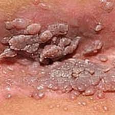 Traitement Naturel des Condylomes