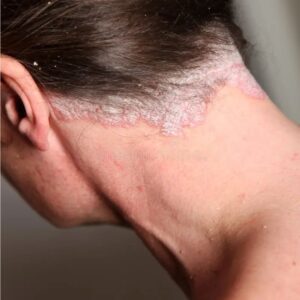 Traitement Naturel du Psoriasis