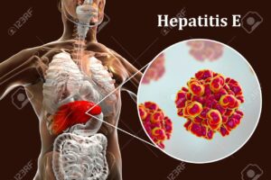 Hépatite B Causes Symptômes Complications Thérapie Naturelle