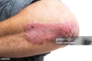 Psoriasis Solution Naturelle