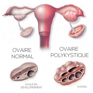 Ovaires Polykystiques Traitement Naturel