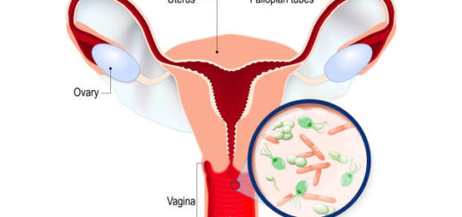 Vaginite Causes Symptômes Prévention Solution Naturelle contre la Vaginite