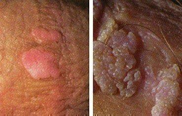 Pillomavirus Solution Naturelle