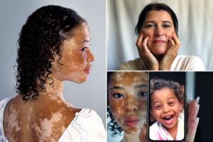 Vitiligo Causes Symptômes Traitement Naturel du Vitiligo