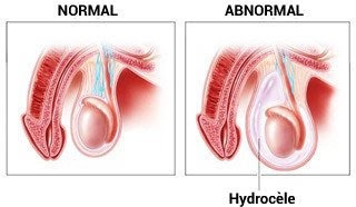 Hydrocèle Testiculaire Solution Naturelle