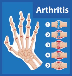 Arthrite Causes Symptômes Prévention Thérapie Naturelle