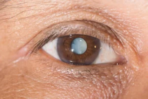 Cataracte Solution Naturelle