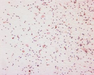 Infertilité Masculine Causes Symptômes Asthénospermie Remède Naturel