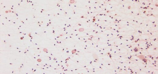 Infertilité Masculine Causes Symptômes Asthénospermie Remède Naturel