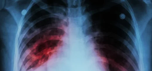 Tuberculose Causes Symptômes Remède Naturel de la Tuberculose