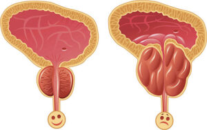 Prostatite Causes Symptômes Remède Naturel Prostatite