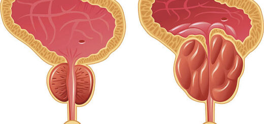 Prostatite Causes Symptômes Remède Naturel Prostatite