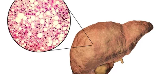 Stéatose Hépatique Causes Symptômes Remède Naturel
