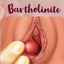 Bartholinite Causes Symptômes Prévention et Traitement Naturel