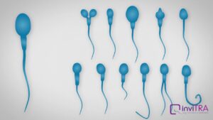 Tératospermie Causes Symptômes Traitement Naturel Sûr de la Tératospermie